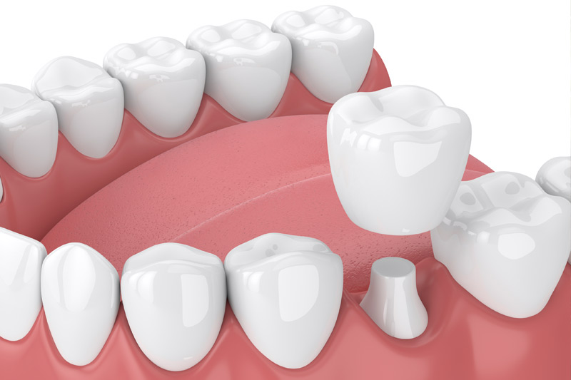 Dental Crowns in Ellicott City