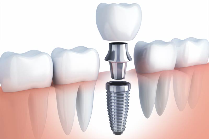 Implants Dentist in Ellicott City