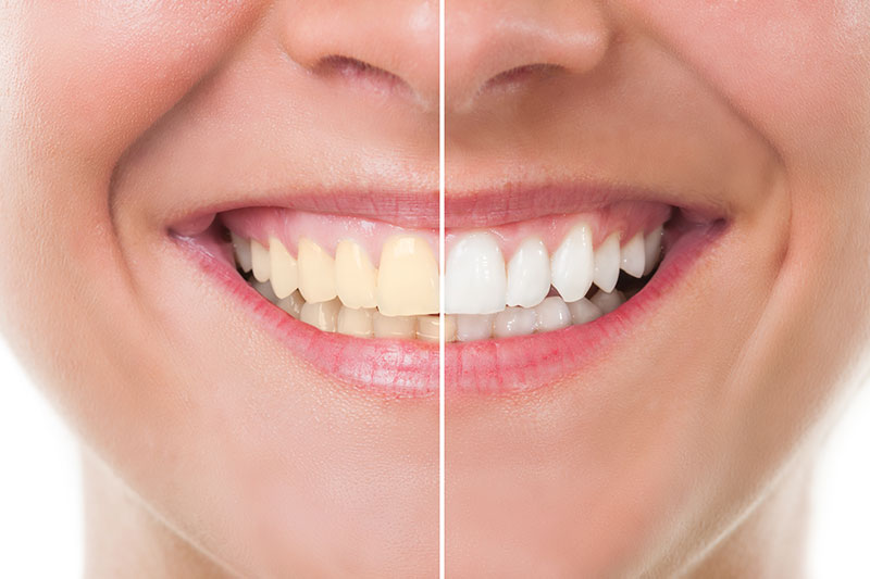 Teeth Whitening in Ellicott City