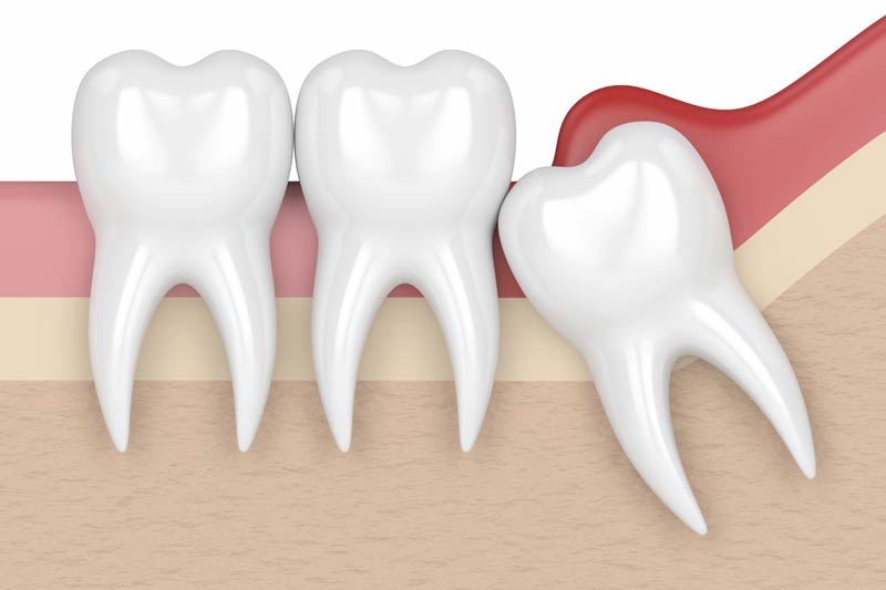 Wisdom Tooth Removal in Ellicott City